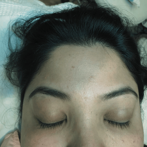 gallery image of tattoo removal